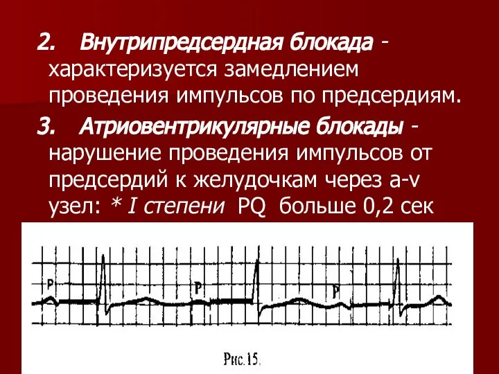 2. Внутрипредсердная блокада - характеризуется замедлением проведения импульсов по предсердиям. 3.