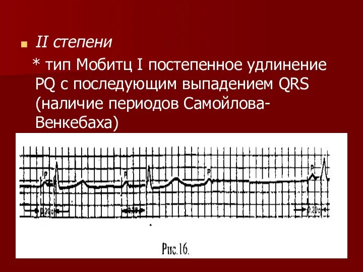 II степени * тип Мобитц I постепенное удлинение PQ с последующим выпадением QRS (наличие периодов Самойлова-Венкебаха)