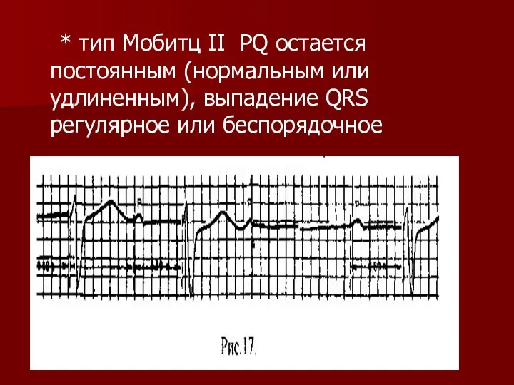 * тип Мобитц II PQ остается постоянным (нормальным или удлиненным), выпадение QRS регулярное или беспорядочное