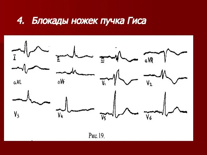 4. Блокады ножек пучка Гиса