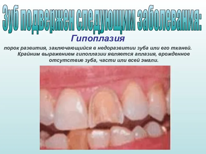 Гипоплазия порок развития, заключающийся в недоразвитии зуба или его тканей. Крайним