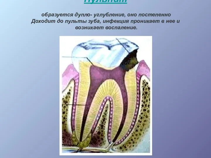Пульпит образуется дупло- углубление, оно постепенно Доходит до пульты зуба, инфекция