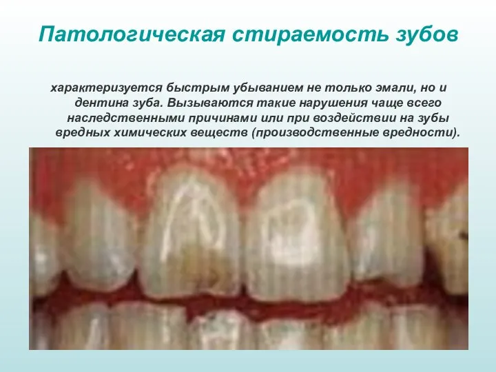 Патологическая стираемость зубов характеризуется быстрым убыванием не только эмали, но и