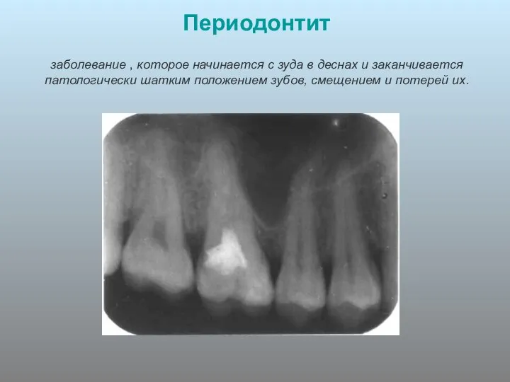 Периодонтит заболевание , которое начинается с зуда в деснах и заканчивается