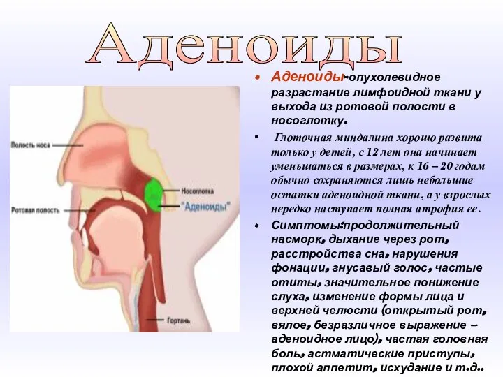 Аденоиды-опухолевидное разрастание лимфоидной ткани у выхода из ротовой полости в носоглотку.