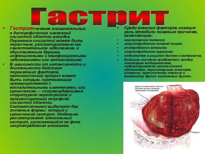 Гастрит-течение воспалительных и дистрофических изменений слизистой оболочки желудка. Поражение слизистой может