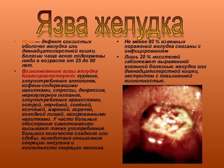 Язва — дефект слизистых оболочек желудка или двенадцатиперстной кишки. Болезни чаще