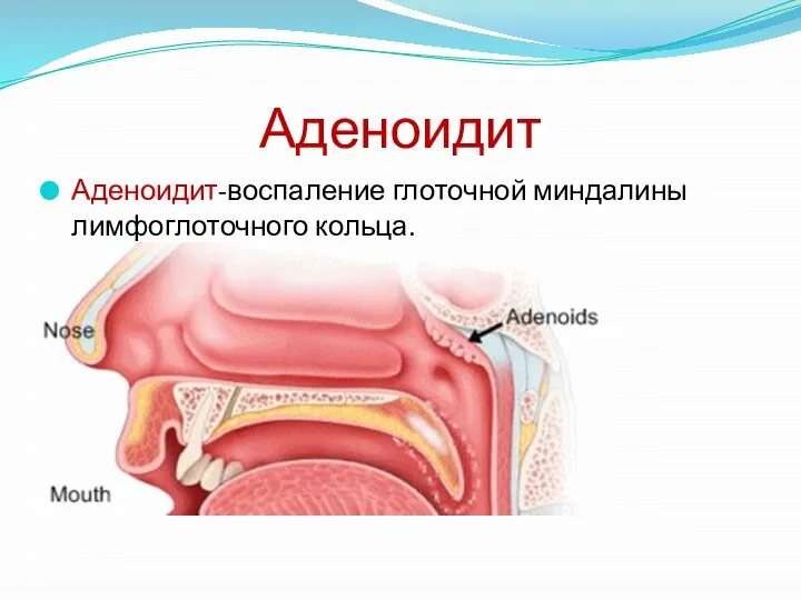 Аденоидит-воспаление глоточной миндалины лимфоглоточного кольца. Аденоидит
