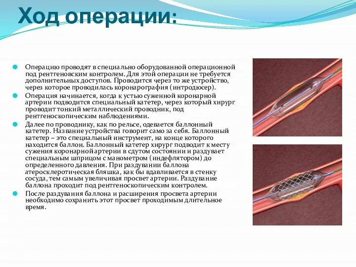 Ход операции: Операцию проводят в специально оборудованной операционной под рентгеновским контролем.