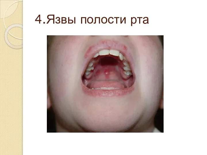 4.Язвы полости рта