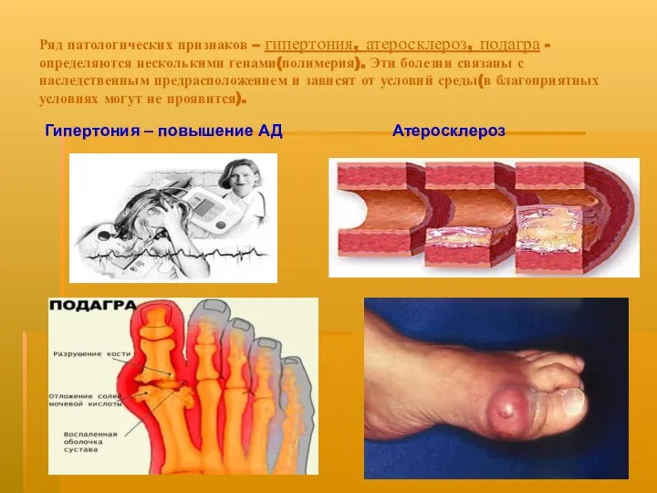 Ряд патологических признаков – гипертония, атеросклероз, подагра - определяются несколькими генами(полимерия).