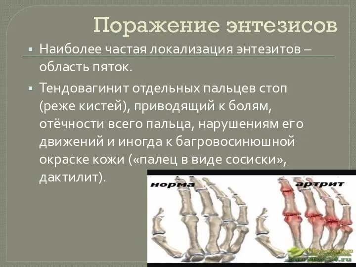 Поражение энтезисов Наиболее частая локализация энтезитов – область пяток. Тендовагинит отдельных