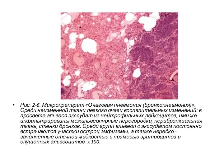 Рис. 2-6. Микропрепарат «Очаговая пневмония (бронхопневмония)». Среди неизменной ткани легкого очаги