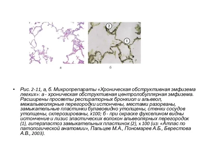 Рис. 2-11, а, б. Микропрепараты «Хроническая обструктивная эмфизема легких»: а -
