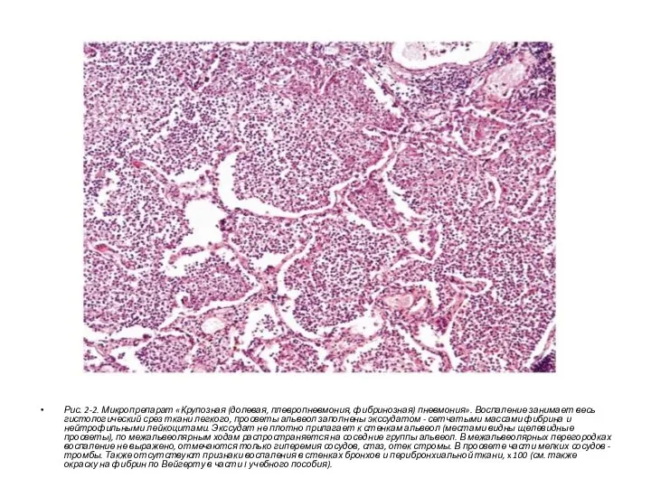 Рис. 2-2. Микропрепарат «Крупозная (долевая, плевропневмония, фибринозная) пневмония». Воспаление занимает весь