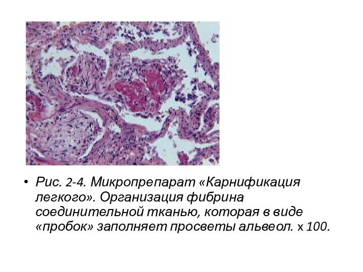 Рис. 2-4. Микропрепарат «Карнификация легкого». Организация фибрина соединительной тканью, которая в