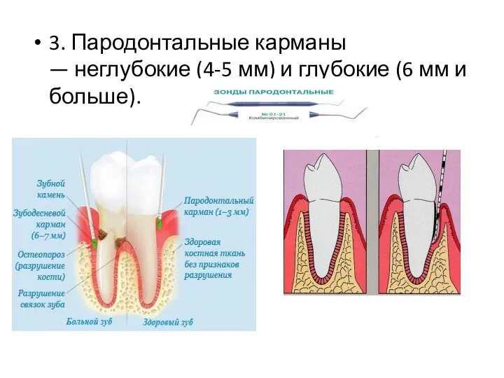 3. Пародонтальные карманы — неглубокие (4-5 мм) и глубокие (6 мм и больше).