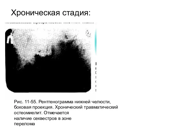 Хроническая стадия: Рис. 11-55. Рентгенограмма нижней челюсти, боковая проекция. Хронический травматический