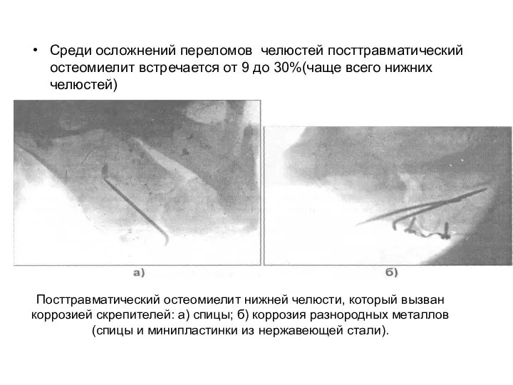 Среди осложнений переломов челюстей посттравматический остеомиелит встре­чается от 9 до 30%(чаще