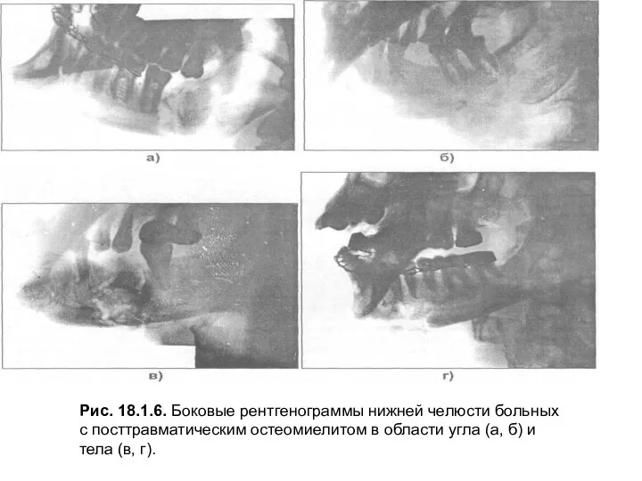 Рис. 18.1.6. Боковые рентгенограммы нижней челюсти больных с посттравматическим остеомиелитом в