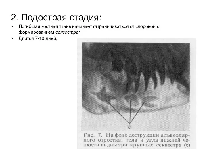 2. Подострая стадия: Погибшая костная ткань начинает отграничиваться от здоровой с формированием секвестра; Длится 7-10 дней;
