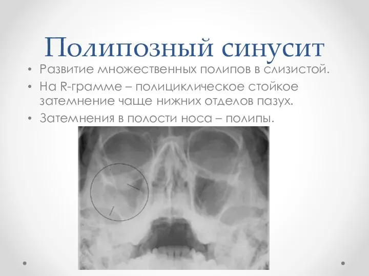 Полипозный синусит Развитие множественных полипов в слизистой. На R-грамме – полициклическое