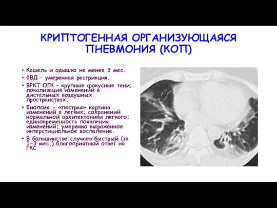 КРИПТОГЕННАЯ ОРГАНИЗУЮЩАЯСЯ ПНЕВМОНИЯ (КОП) Кашель и одышка не менее 3 мес.