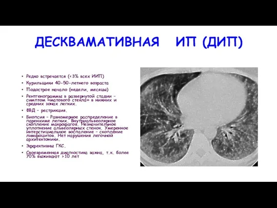 ДЕСКВАМАТИВНАЯ ИП (ДИП) Редко встречается ( Курильщики 40-50-летнего возраста Подострое начало