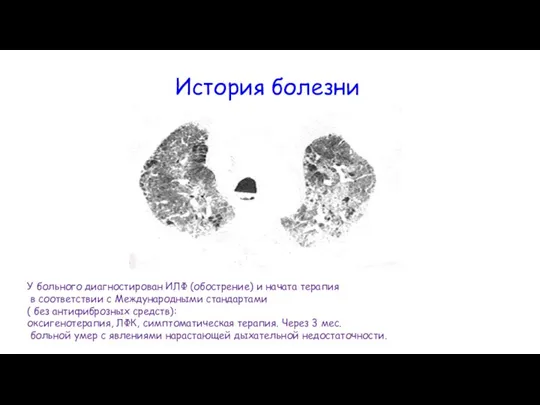 История болезни У больного диагностирован ИЛФ (обострение) и начата терапия в