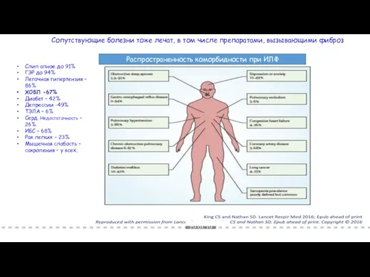 Распространенность коморбидности при ИЛФ Слип апное до 91% ГЭР до 94%
