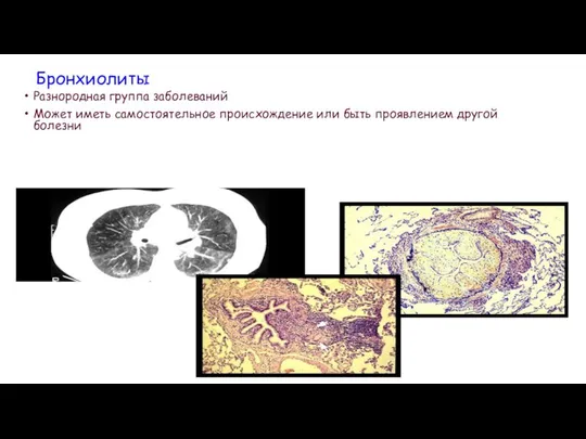 Бронхиолиты Разнородная группа заболеваний Может иметь самостоятельное происхождение или быть проявлением другой болезни