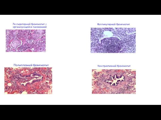 Респираторный бронхиолит с организующейся пневмонией Фолликулярный бронхиолит Полиппозный бронхиолит Констриктивный бронхиолит
