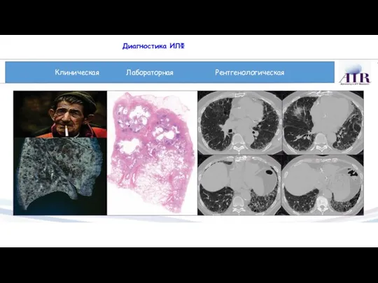 Диагностика ИЛФ Клиническая Лабораторная Рентгенологическая