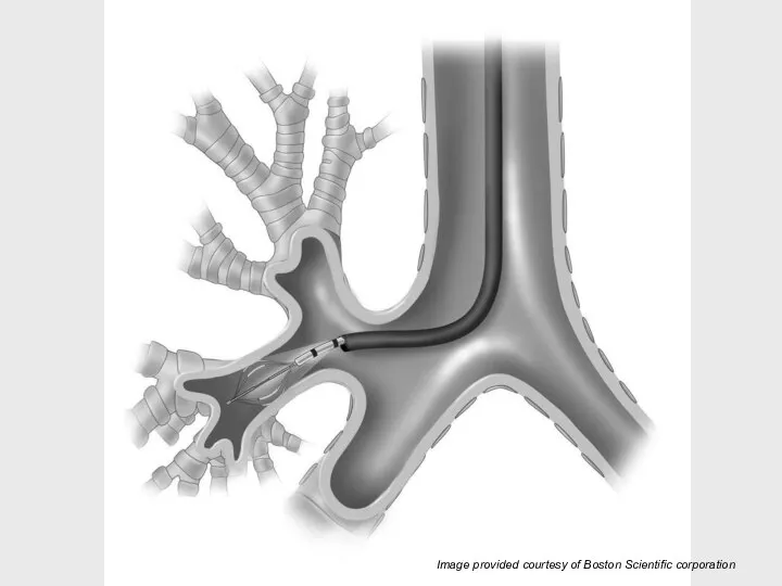 Image provided courtesy of Boston Scientific corporation