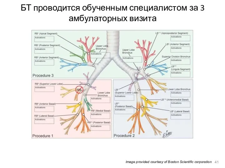 БТ проводится обученным специалистом за 3 амбулаторных визита 41 Image provided courtesy of Boston Scientific corporation