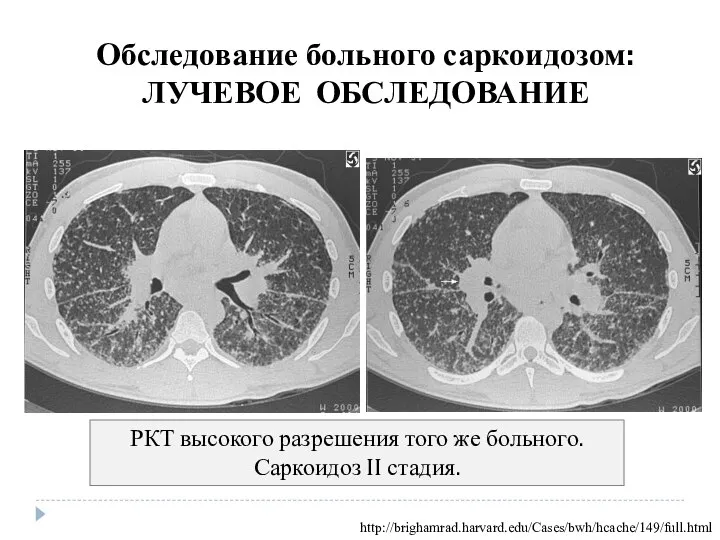 РКТ высокого разрешения того же больного. Саркоидоз II стадия. Обследование больного саркоидозом: ЛУЧЕВОЕ ОБСЛЕДОВАНИЕ http://brighamrad.harvard.edu/Cases/bwh/hcache/149/full.html