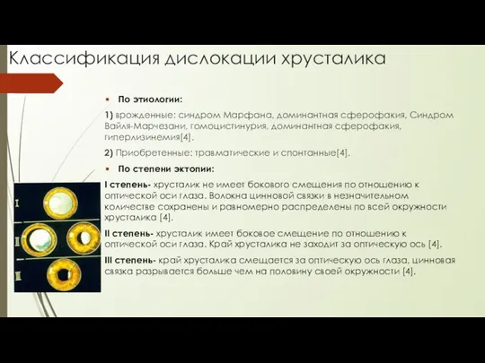 Классификация дислокации хрусталика По этиологии: 1) врожденные: синдром Марфана, доминантная сферофакия,