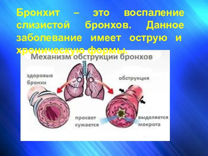 Бронхит – это воспаление слизистой бронхов. Данное заболевание имеет острую и хроническую формы.