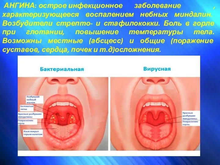 АНГИНА: острое инфекционное заболевание ,характеризующееся воспалением небных миндалин. Возбудители стрепто- и