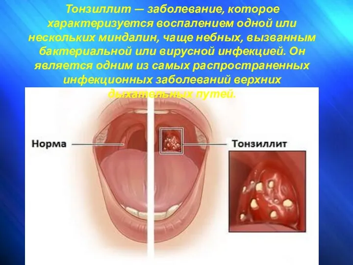 Тонзиллит — заболевание, которое характеризуется воспалением одной или нескольких миндалин, чаще