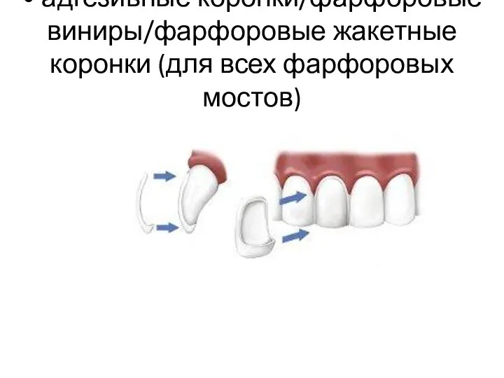 • адгезивные коронки/фарфоровые виниры/фарфоровые жакетные коронки (для всех фарфоровых мостов)