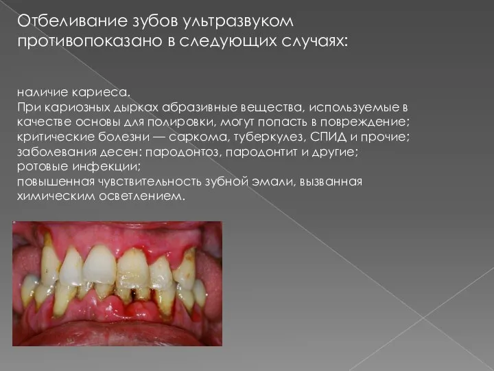 Отбеливание зубов ультразвуком противопоказано в следующих случаях: наличие кариеса. При кариозных