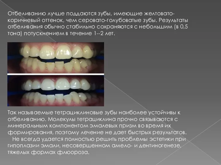 Отбеливанию лучше поддаются зубы, имеющие желтовато-коричневый оттенок, чем серовато-голубоватые зубы. Результаты