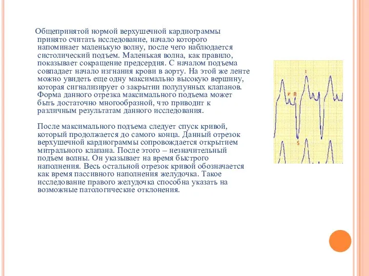 Общепринятой нормой верхушечной кардиограммы принято считать исследование, начало которого напоминает маленькую