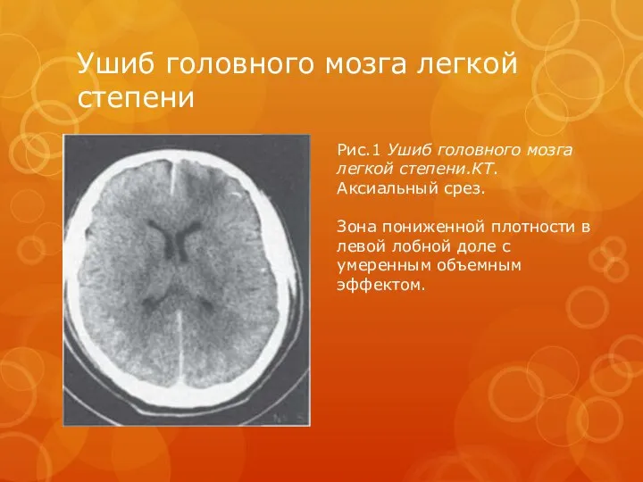 Ушиб головного мозга легкой степени Рис.1 Ушиб головного мозга легкой степени.КТ.