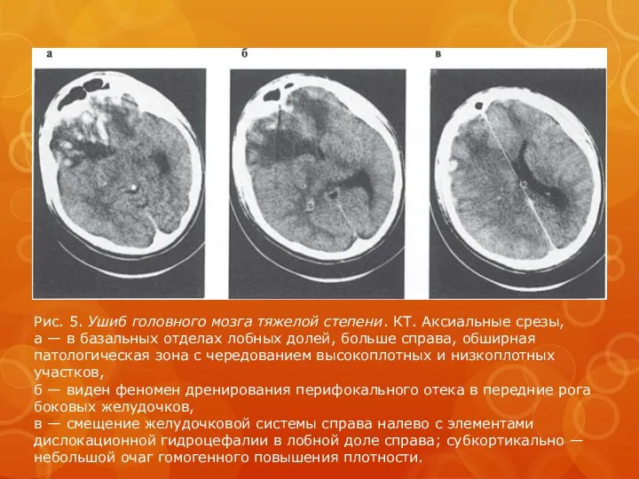 Рис. 5. Ушиб головного мозга тяжелой степени. КТ. Аксиальные срезы, а