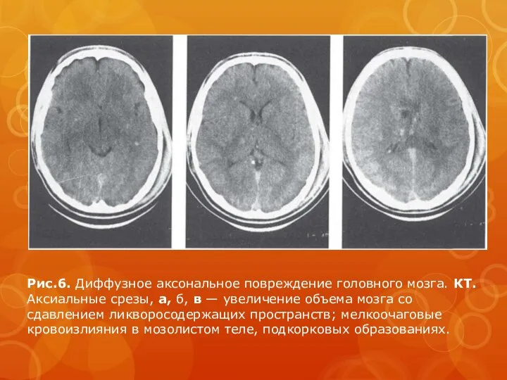 Рис.6. Диффузное аксональное повреждение головного мозга. КТ. Аксиальные срезы, а, б,