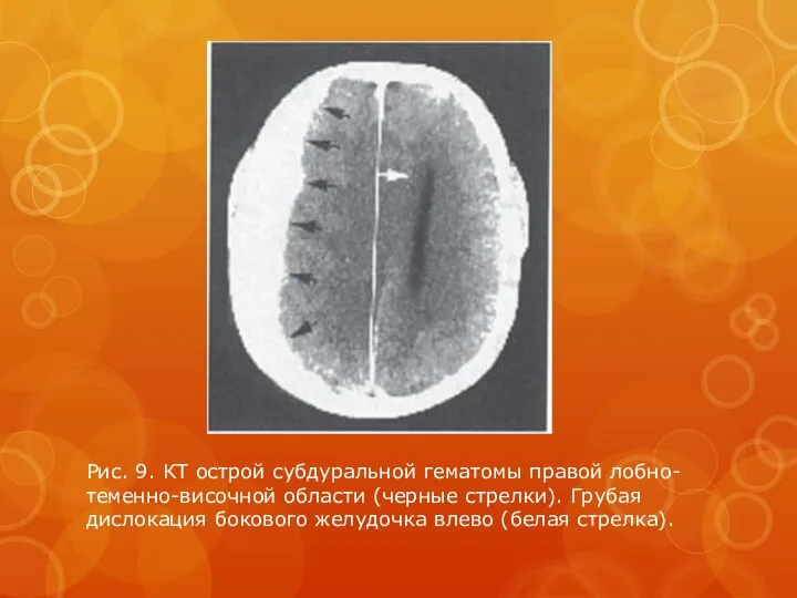 Рис. 9. КТ острой субдуральной гематомы правой лобно- теменно-височной области (черные