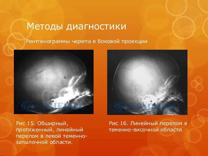 Методы диагностики Рентгенограммы черепа в боковой проекции Рис 15. Обширный, протяженный,