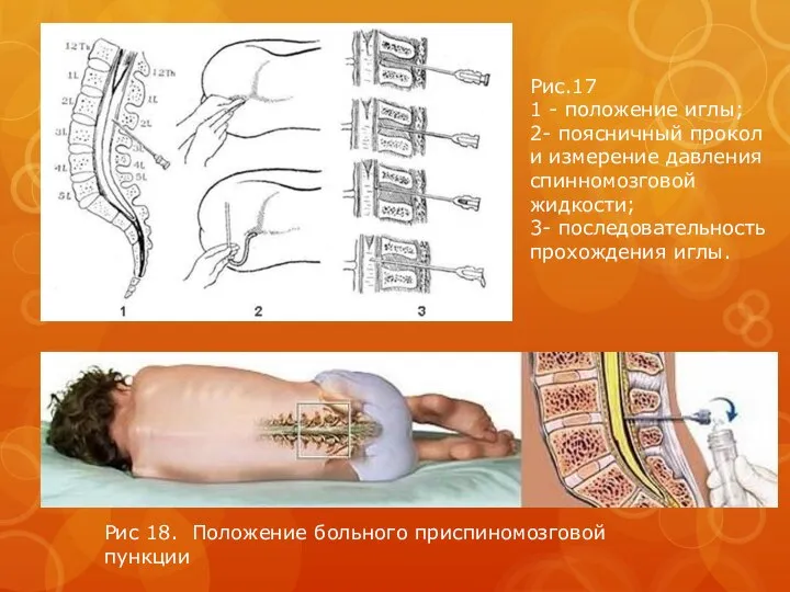 Рис 18. Положение больного приспиномозговой пункции Рис.17 1 - положение иглы;